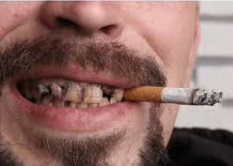 How Smoking Affects Oral Health?