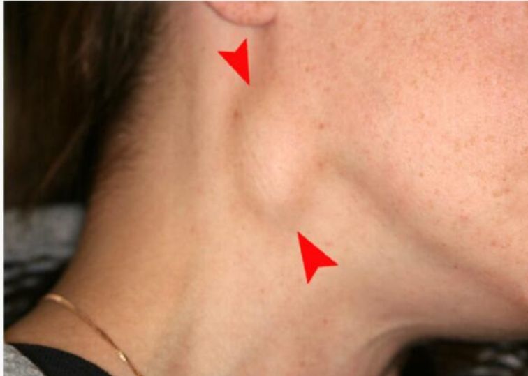 How Bad is Lymphoma Cancer?