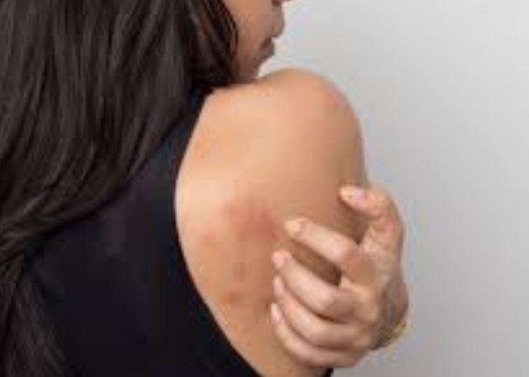What Cancer Can Cause Itchy Skin?